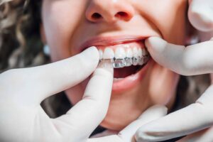Say Goodbye to Braces: The Advantages of Clear Aligner Treatment