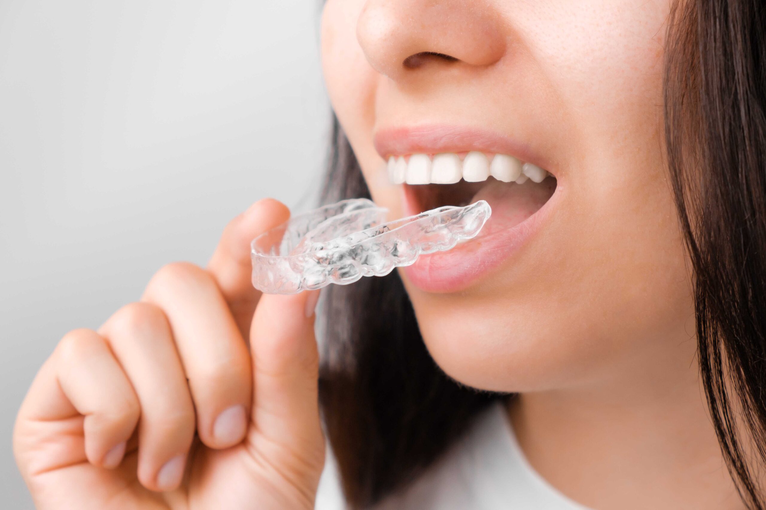 Benefits Of Clear Aligners