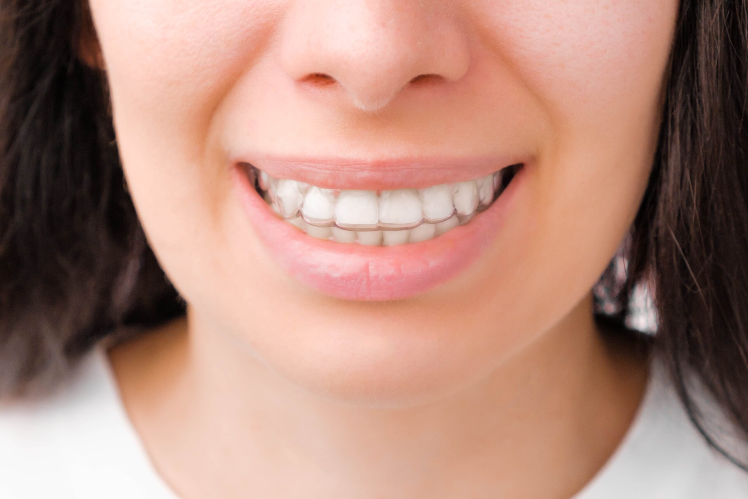 Clear Aligners For Overbite