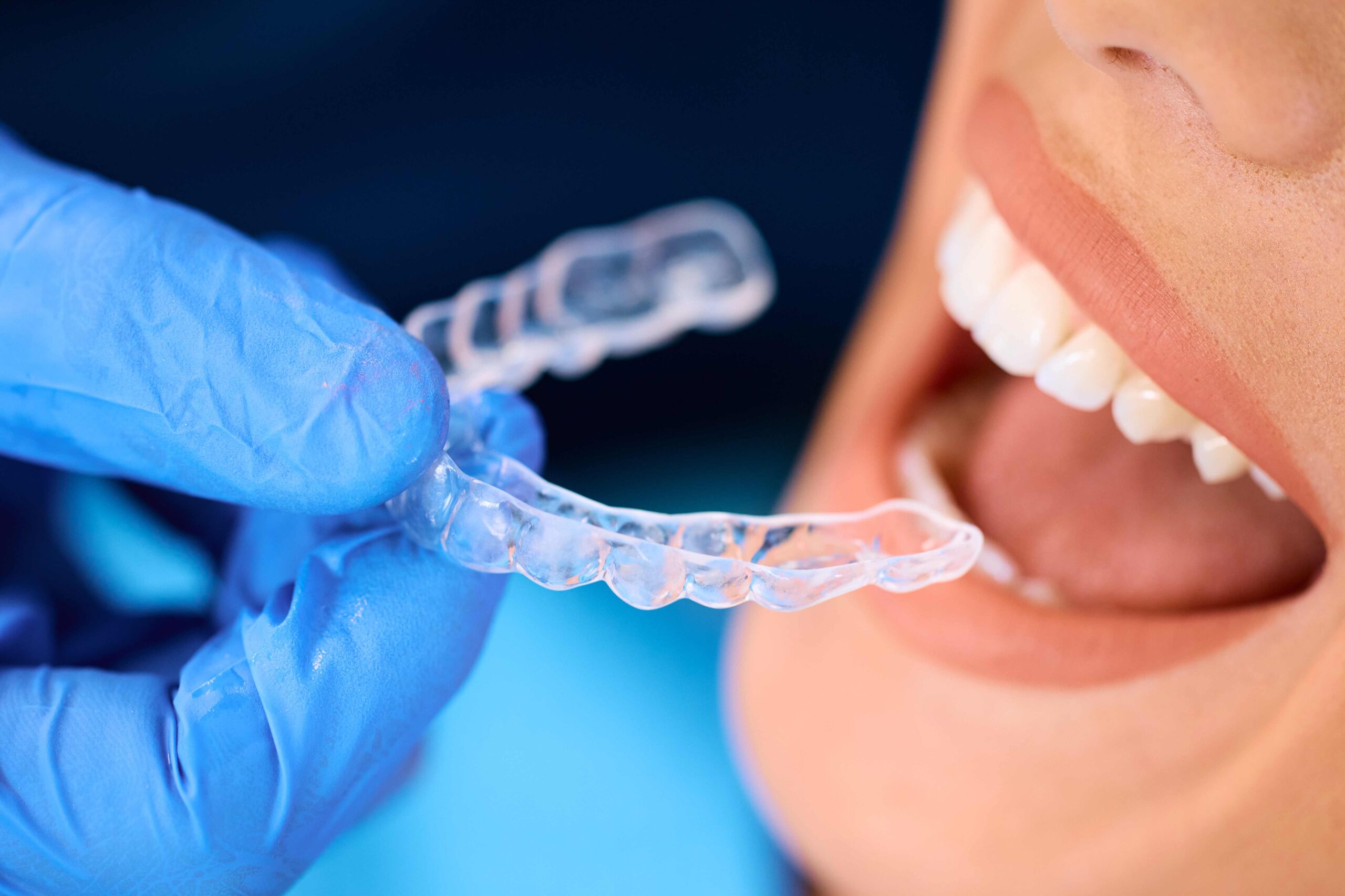 Clear Aligners For Teeth