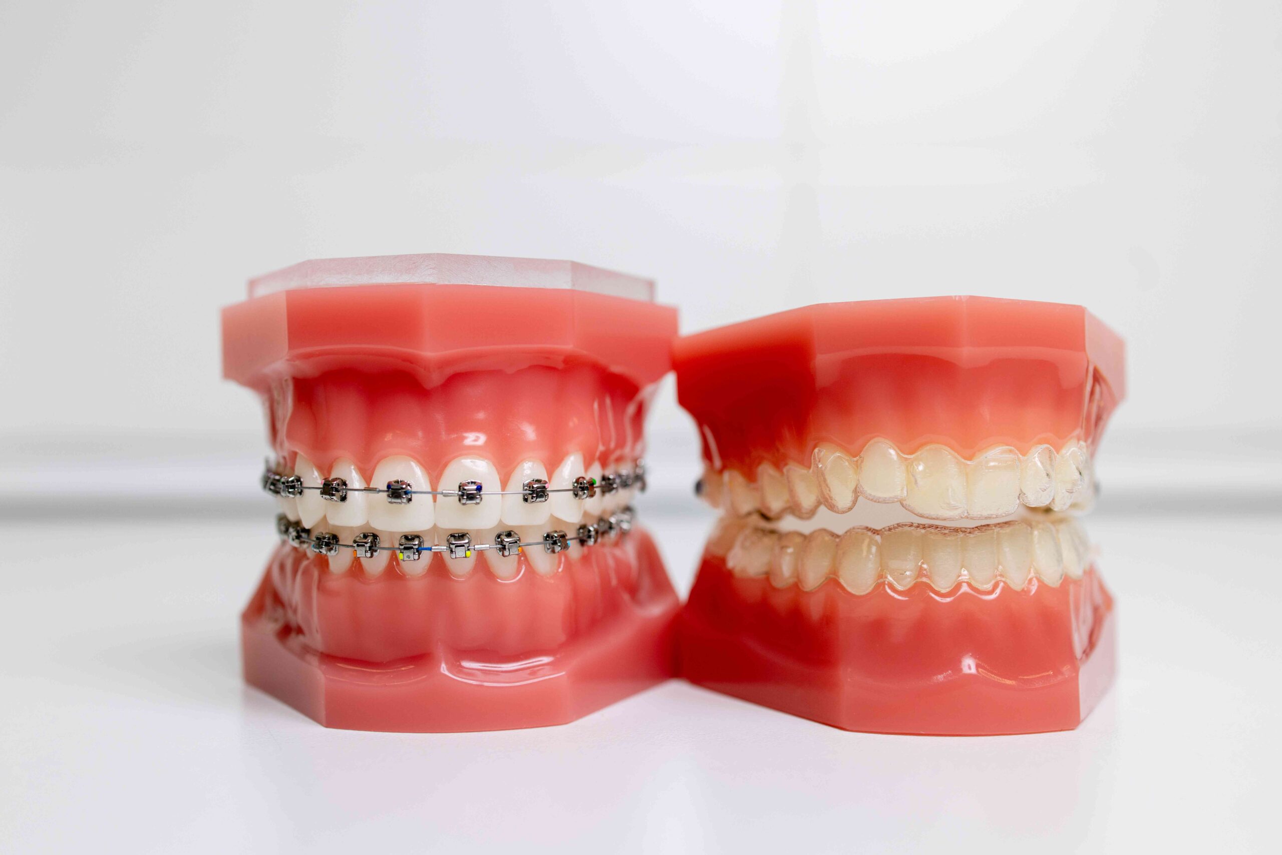Clear Aligners VS Traditional Braces