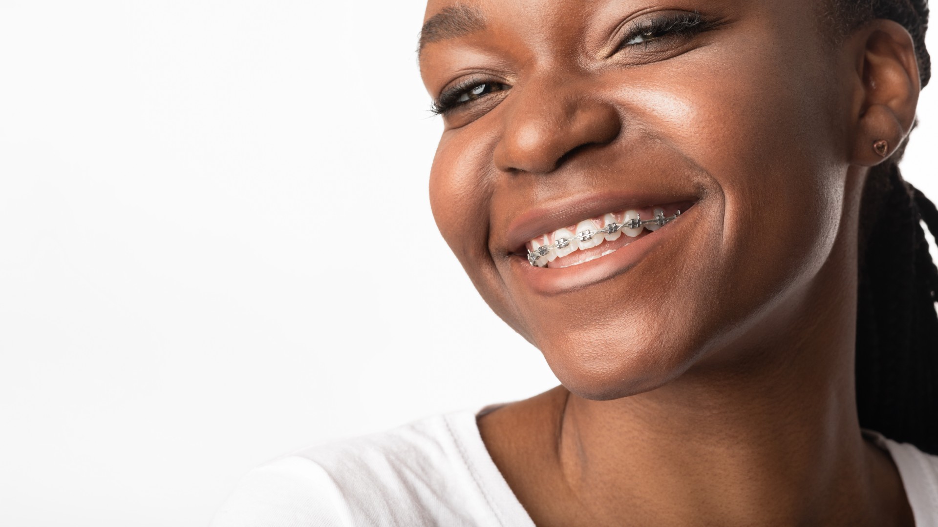 Traditional Braces