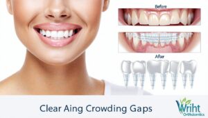 how clear aligners correct crowding and gaps