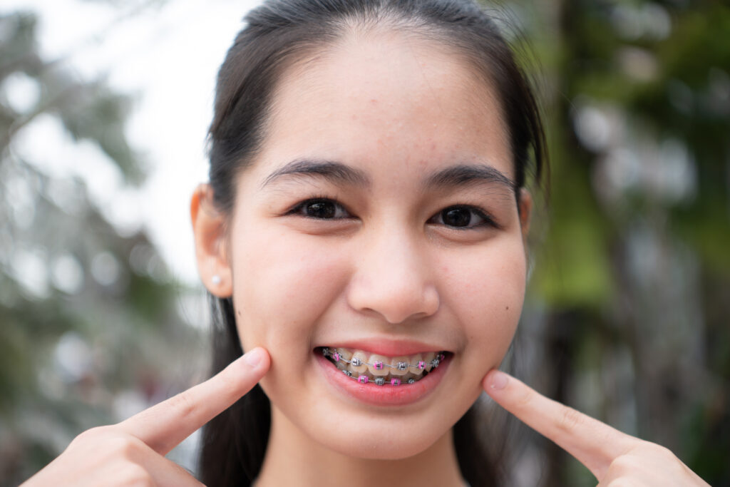 orthodontic-treatment-for-spacing