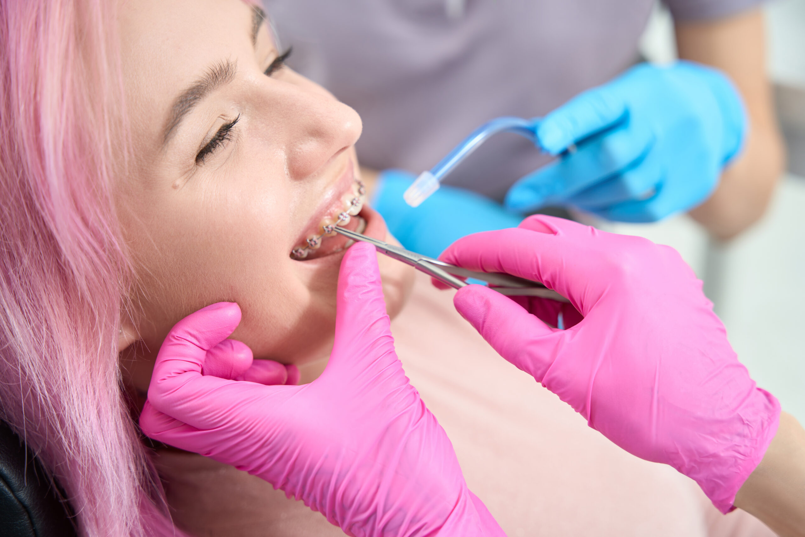 sealant-application-during-braces