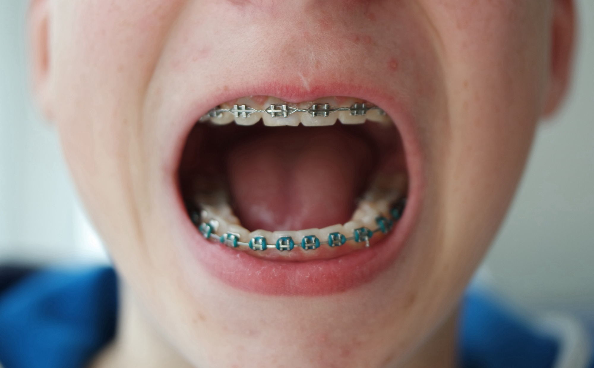 Mouth open with teeth and braces. Teenage skin, beauty and health.