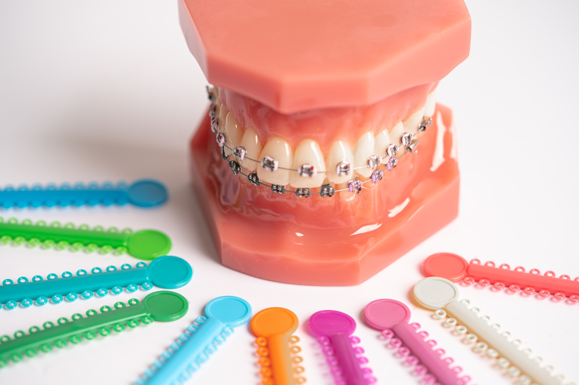 Orthodontic ligatures rings and ties, elastic rubber bands on orthodontic braces.