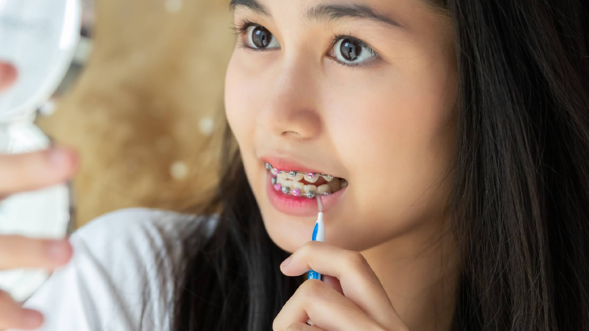 What to Expect from Your Ceramic Braces Treatment Journey