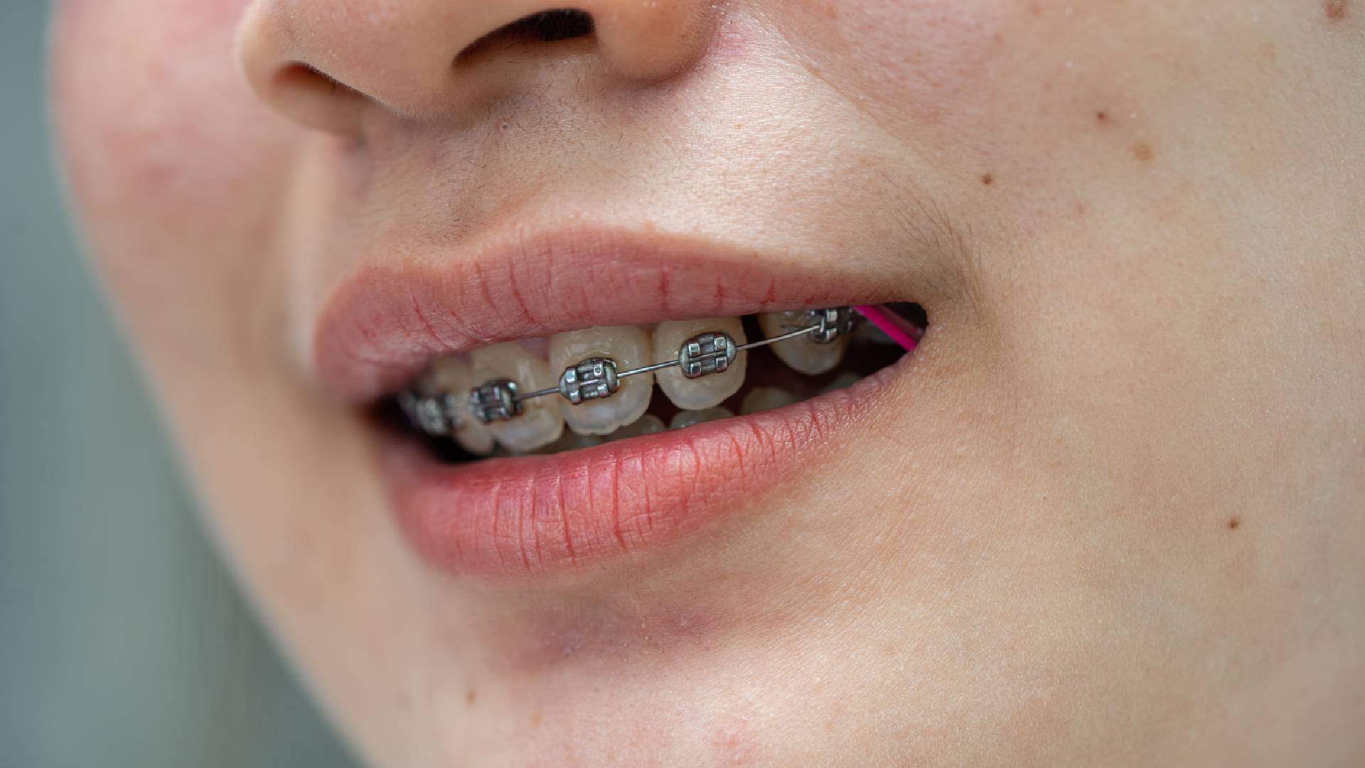 Orthodontic Corrective Procedures: Clear Solutions for Jaw Misalignment
