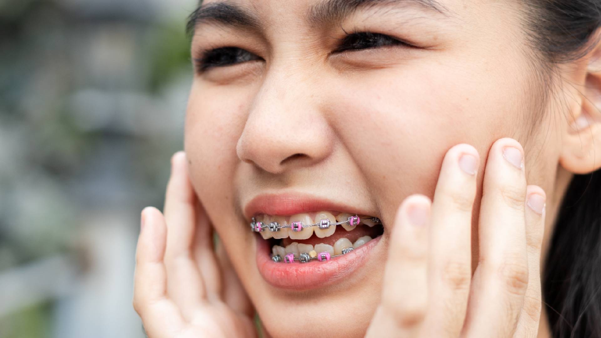 Proven Orthodontic Treatment for Crowding to Fix Jaw Alignment